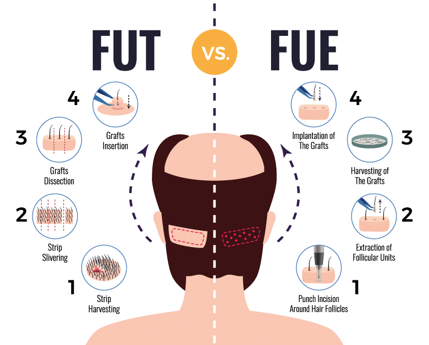 FUE-FUT-hair transplantation