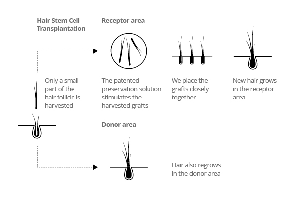 Hair Stem Cell Transplantation Technique