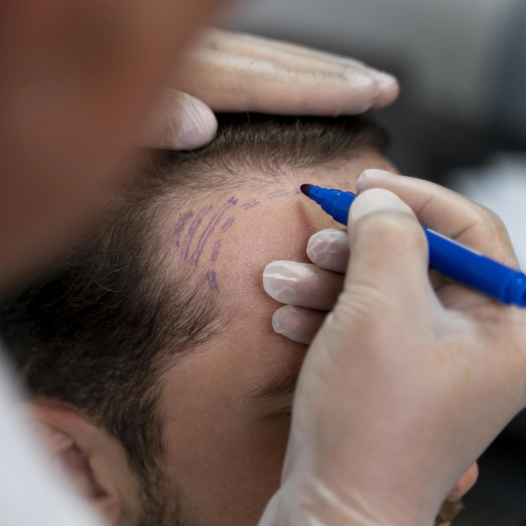 hair loss treatment