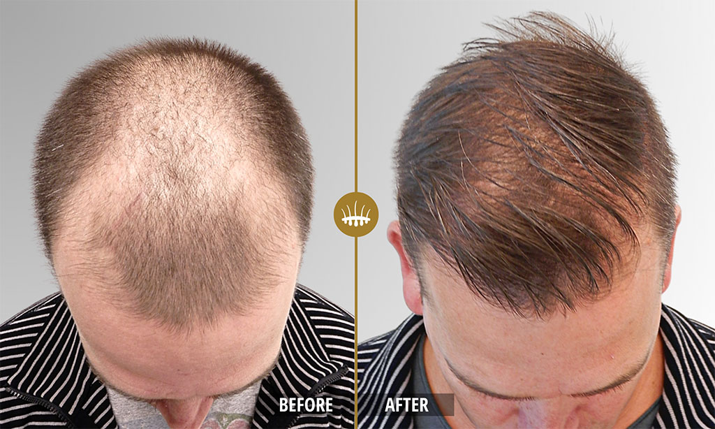 natural results hair men